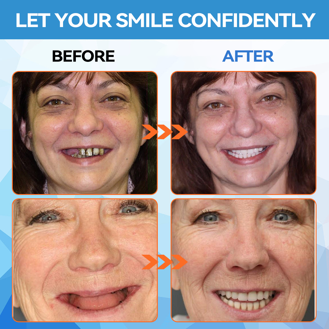 Official Store | Minceetbien™🗽 Moldable Dentures(⏰Limited Time 80% Off - Last 30 Minutes ⏰)